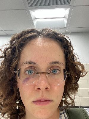 Black eye from lap swimming (it was my fault)